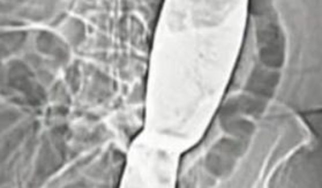 Kirurzi zaboravili lopaticu u tijelu pacijentice nakon operacije (Metro-portal.hr)