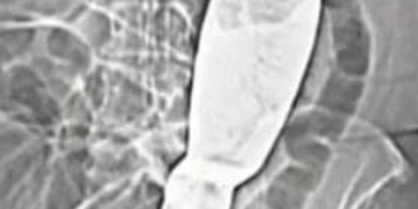 Kirurzi zaboravili lopaticu u tijelu pacijentice nakon operacije (Metro-portal.hr) Kirurzi zaboravili lopaticu u tijelu pacijentice nakon operacije (Metro-portal.hr)