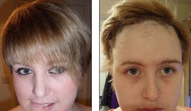 Izgubila pola kose nakon upotrebe novog Pantene šampona; Britanka Sophie Peppercorn (Metro-portal.hr)