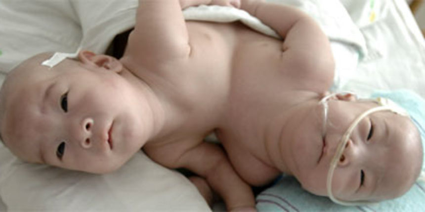 sijamski blizanci sijamski blizanci