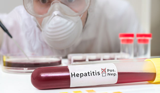 hepatitis