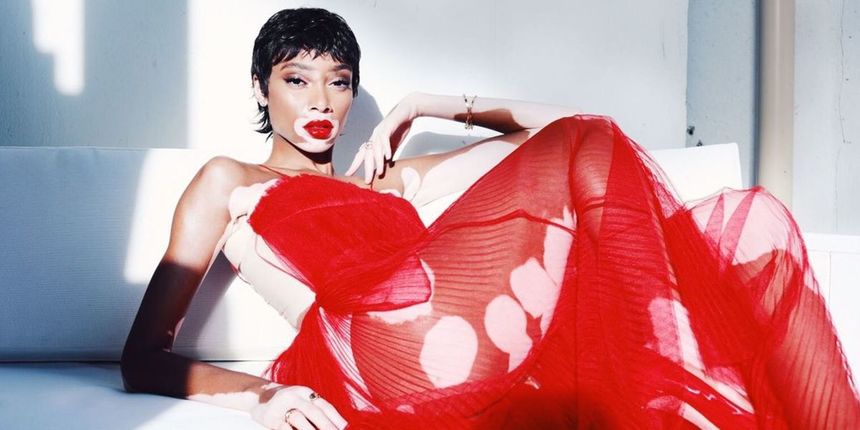 Winnie Harlow Winnie Harlow