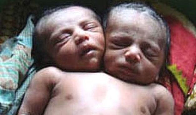 Dvoglavi dječak Kiron (Foto: AP)