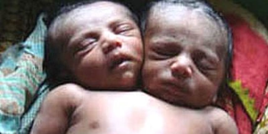 Dvoglavi dječak Kiron (Foto: AP) Dvoglavi dječak Kiron (Foto: AP)