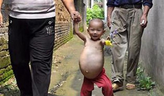 Jednogodišnja djevojčica u trbuhu ima bebu (Tportal.hr)