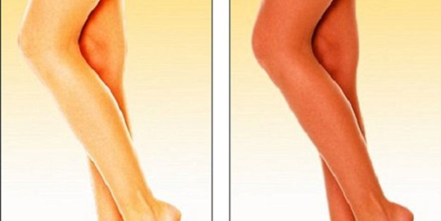 SkinKiss proizveo najlonke koje uklanjaju celulit