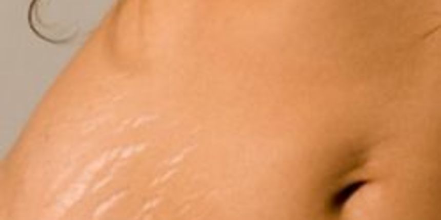 Strije (Zena.hr) Strije (Zena.hr)