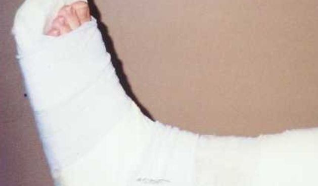 Gips (Foto: miwa-racing.de)