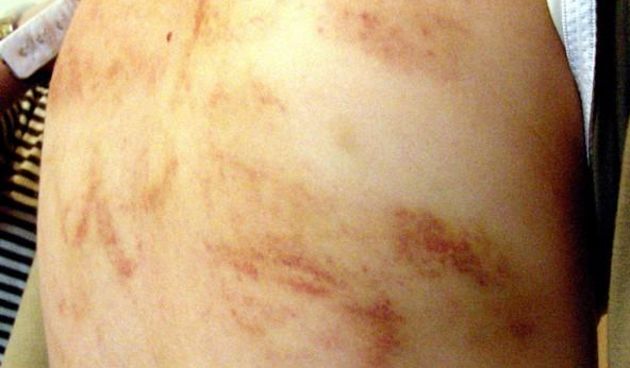 Leđa pretučene djevojčice (Foto:M. Šantoši,24sata)