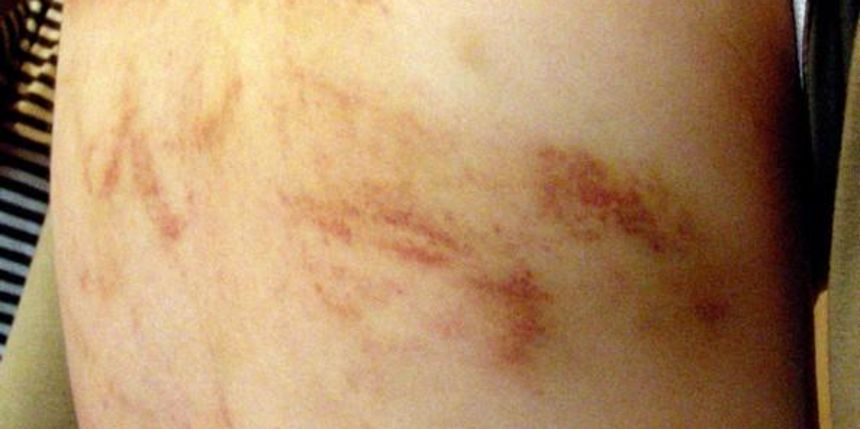 Leđa pretučene djevojčice (Foto:M. Šantoši,24sata)