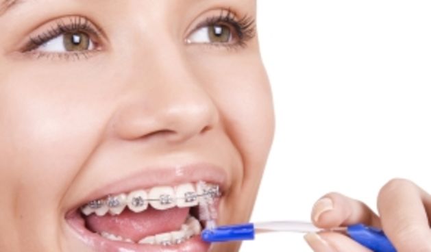 aparatić za zube, foto: ljepotica.si