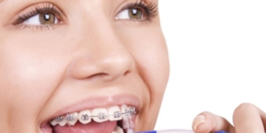 aparatić za zube, foto: ljepotica.si aparatić za zube, foto: ljepotica.si