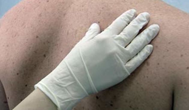 melanom (foto: hrt.hr)