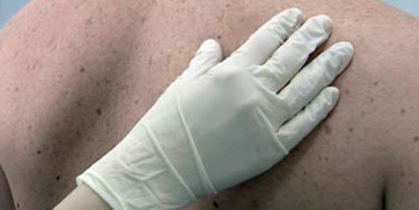 melanom (foto: hrt.hr) melanom (foto: hrt.hr)