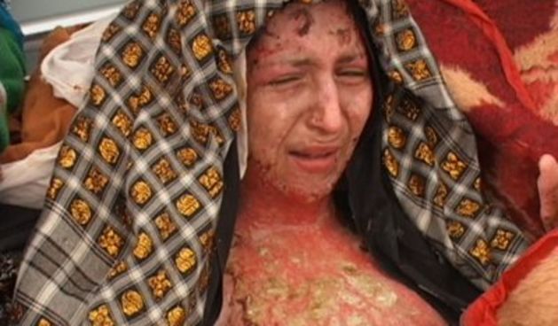 Mlada Indijka – teške opekline (Foto: listverse.com)