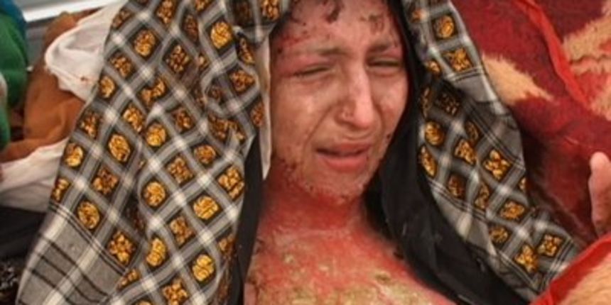 Mlada Indijka – teške opekline (Foto: listverse.com)