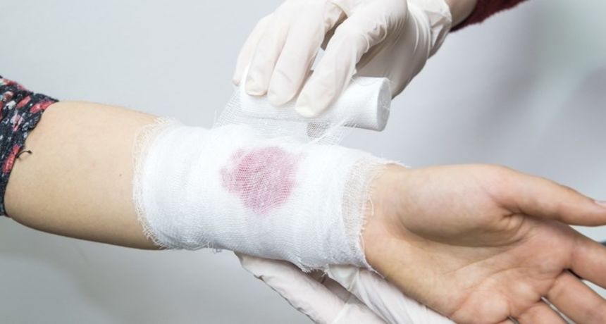 Previjanje rane, rana, zavoj Previjanje rane, rana, zavoj