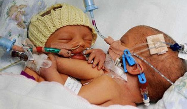 Sijamske blizankinje Williams (Foto: telegraph.co.uk)