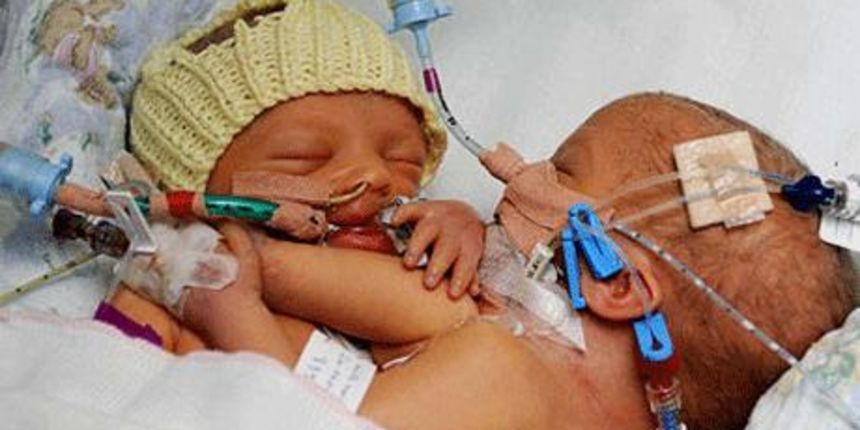 Sijamske blizankinje Williams (Foto: telegraph.co.uk) Sijamske blizankinje Williams (Foto: telegraph.co.uk)