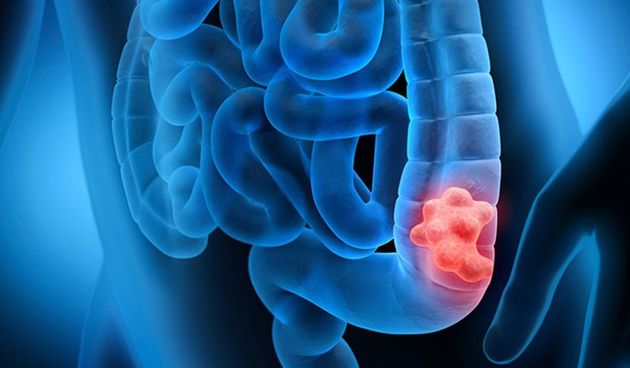 Karcinom debelog crijeva debelo crijevo probava