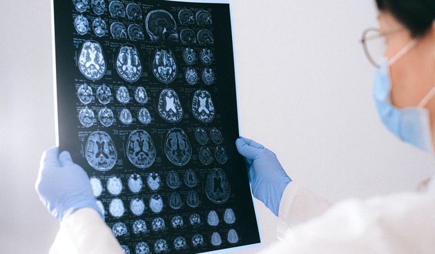 Mozak moždani udar ilustracija