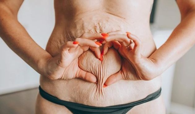 Dijeta, strije, mršavljenje