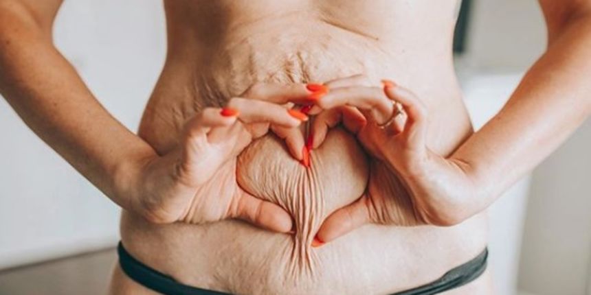 Dijeta, strije, mršavljenje Dijeta, strije, mršavljenje