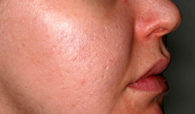 Akne (Foto: uniklinik-freiburg.de)