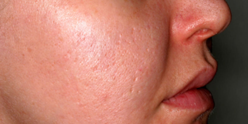 Akne (Foto: uniklinik-freiburg.de) Akne (Foto: uniklinik-freiburg.de)