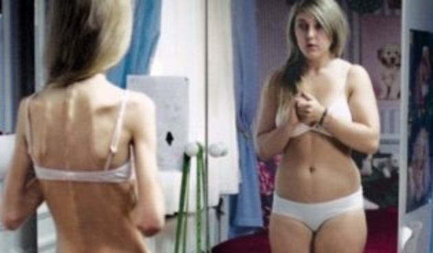 Anoreksija, foto: saznajsve.com