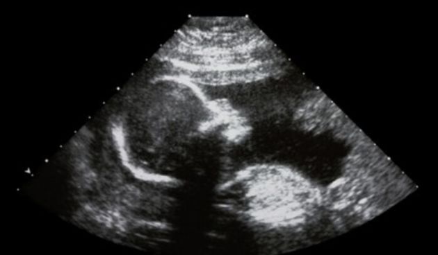 beba, fetus, ultrazvuk (Metro-portal.hr)