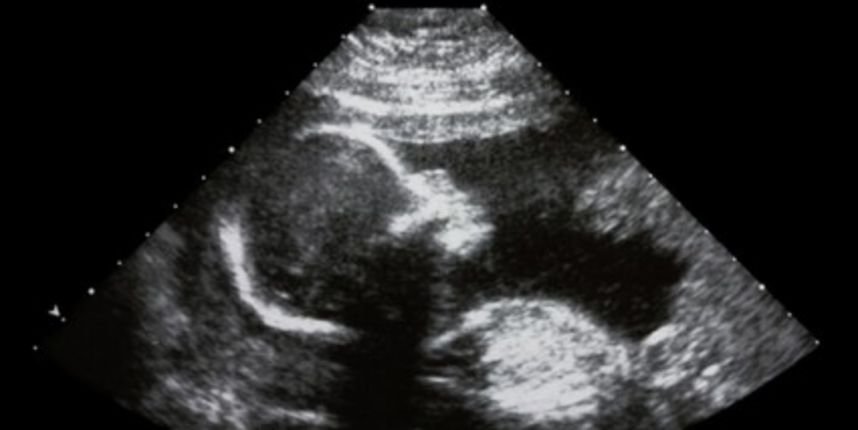 beba, fetus, ultrazvuk (Metro-portal.hr) beba, fetus, ultrazvuk (Metro-portal.hr)