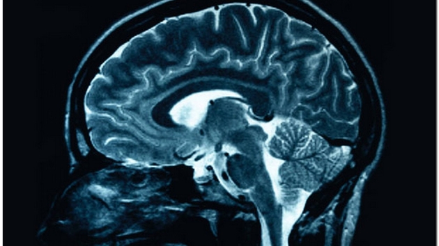 Multipla skleroza – ulje marihuane pomaže kod multiple skleroze, usporavajući njezin progres i ublažavajući simptome