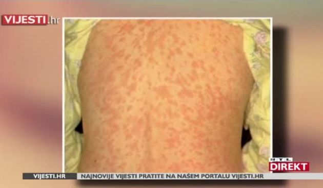 U Hrvatsku vjerojatno stigle ospice, a čak 4000 djece nije cijepljeno!  (thumbnail)