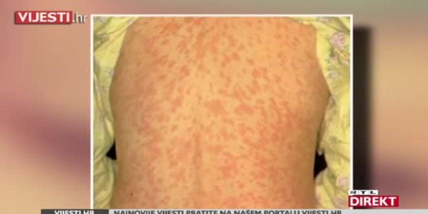 U Hrvatsku vjerojatno stigle ospice, a čak 4000 djece nije cijepljeno! (thumbnail) U Hrvatsku vjerojatno stigle ospice, a čak 4000 djece nije cijepljeno! (thumbnail)